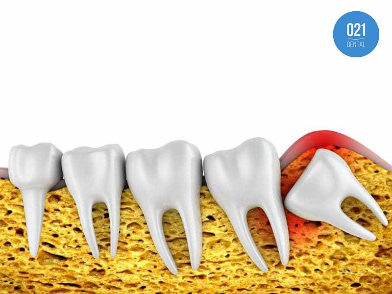 Sintomas do dente do siso nascendo