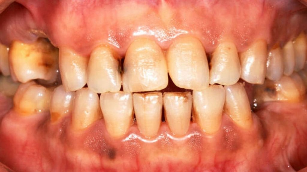 dentes cariados e sem limpeza dentaria