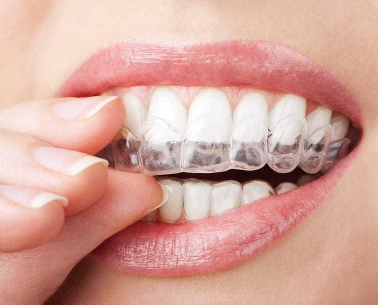 como-comprar-um-kit-de-clareamento-dental-de-forma-segura