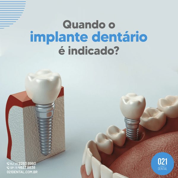 Como Funciona o Implante Dentário