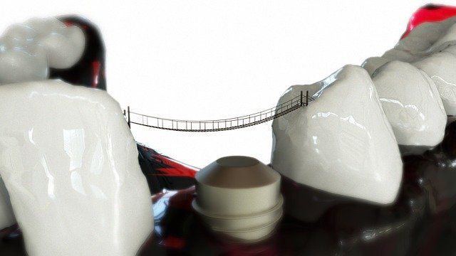 Principais Dúvidas Sobre o Implante Dentário