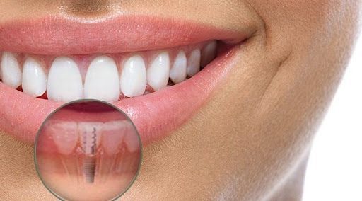 Quando o implante dentário é indicado