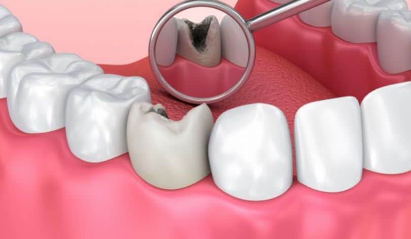 dente com cárie visto pelo espelho