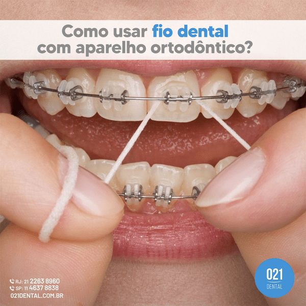 Como usar fio dental com aparelho ortodôntico