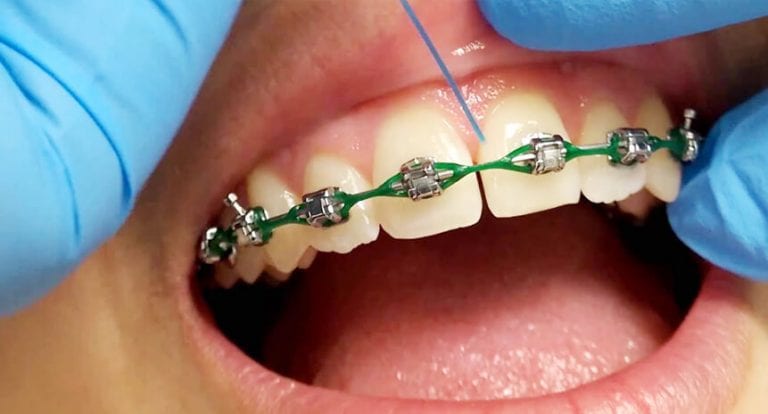 Escovar os dentes com aparelho