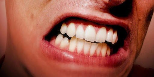Bruxismo e dor de cabeça tem relação