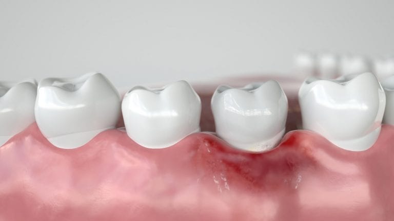 dente com gengiva inflamada