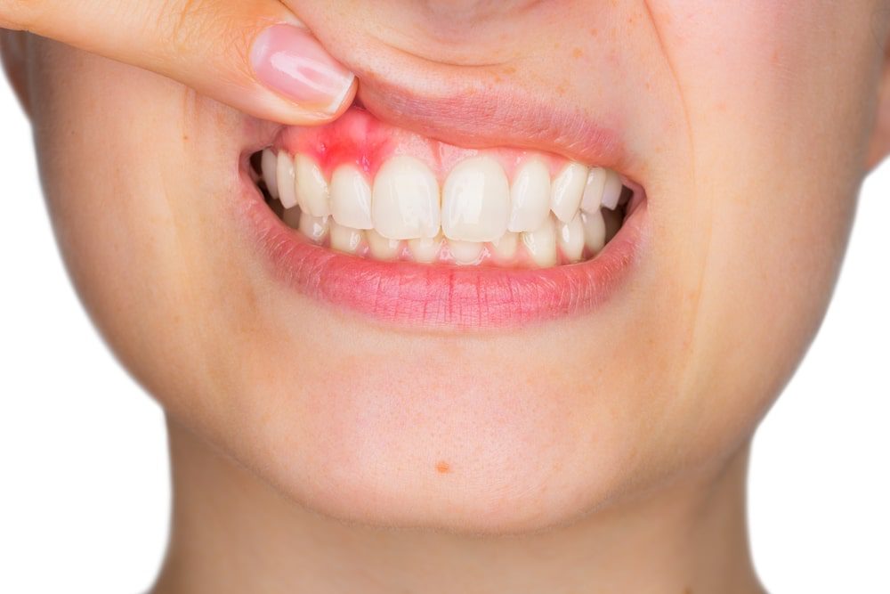 gengiva inflamada e periodontite