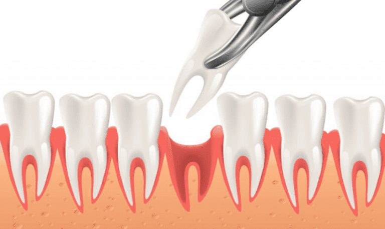 O que comer após extração de dente