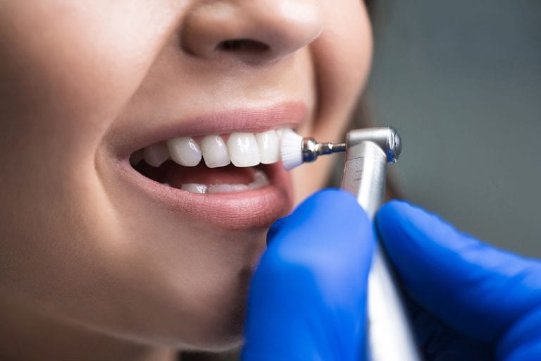 Limpeza dentária tira a cárie