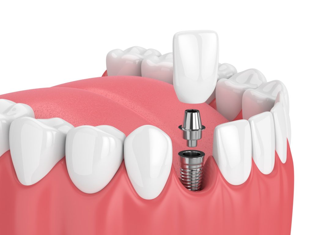 implante dental