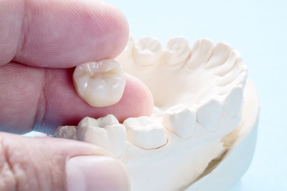 PROTESE DENTAL DE PORCELANA