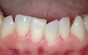 Apinhamento dos dentes