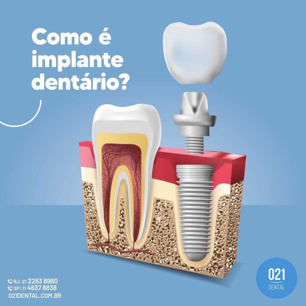 Como é implante dentário