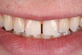 Diastema