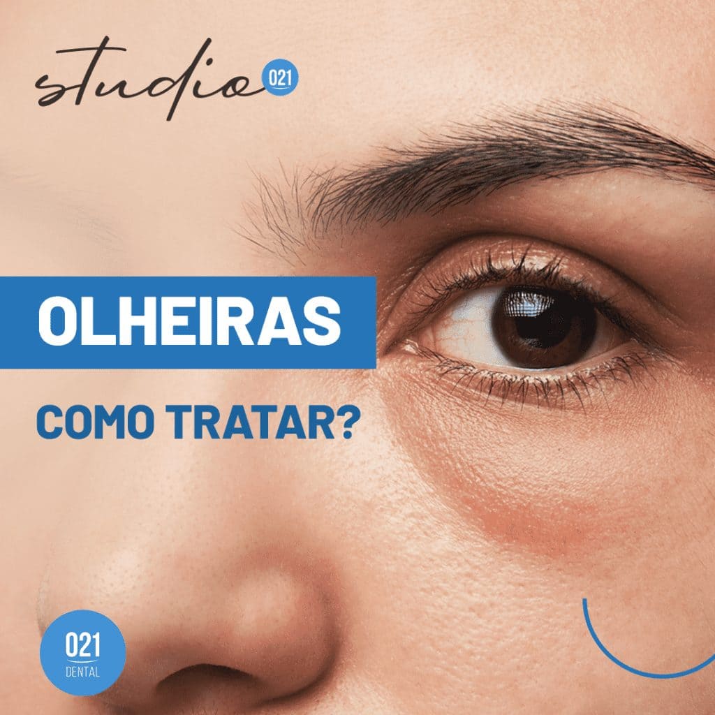 Olheiras como tratar (1)