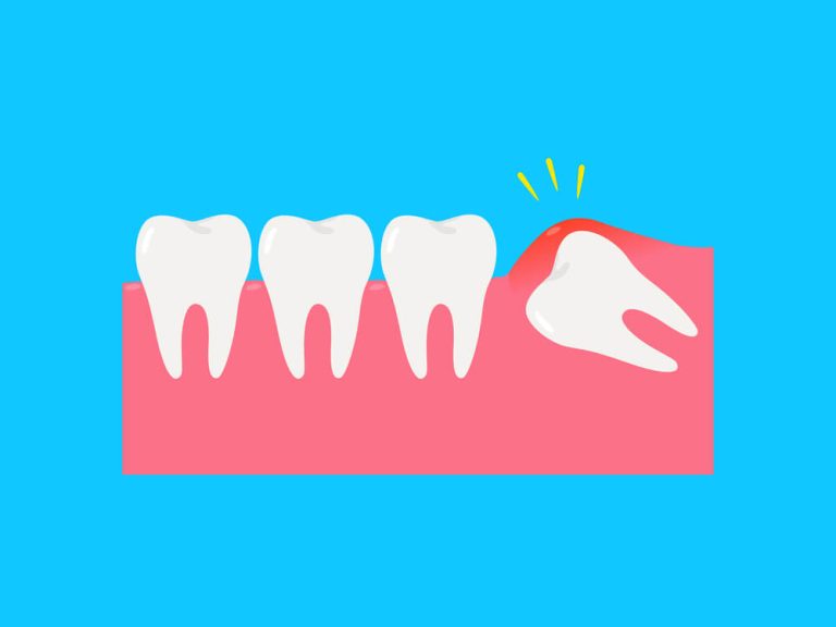 Guia dental sobre o dente do siso