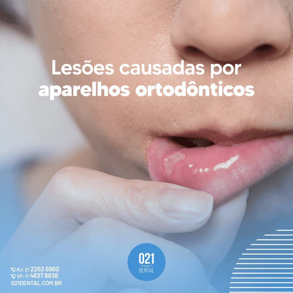 Lesões causadas por aparelhos (1)
