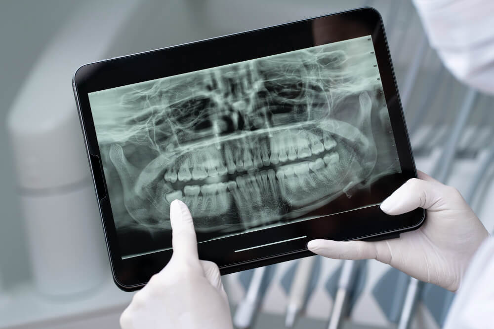 O que fazer quando o dente do siso começar a doer