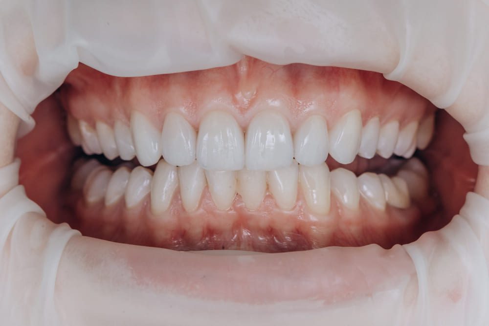 Quanto tempo as lentes de contato dental duram