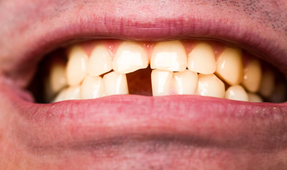 Dentes quebrando Qual é a prevenção