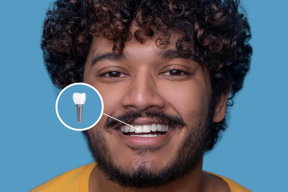 Por que existem diferentes tipos de implantes dentários