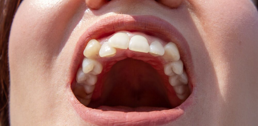 Consequências trazidas pelos dentes tortos