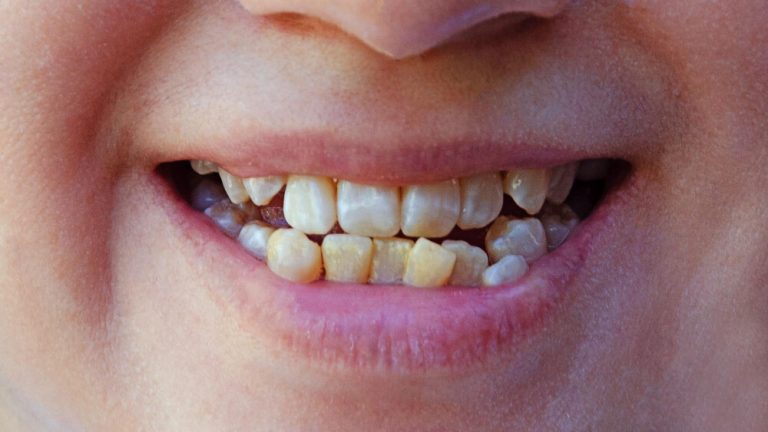 Dentes tortos conheça os possíveis tratamentos