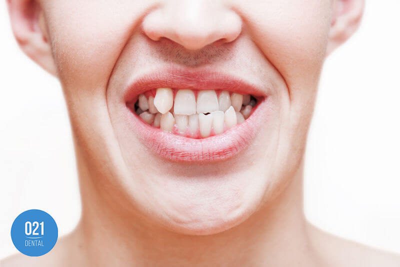 Consequências trazidas pelos dentes tortos
