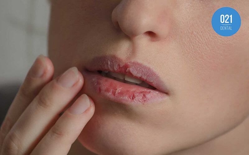 Mulher com lábios secos e machucados