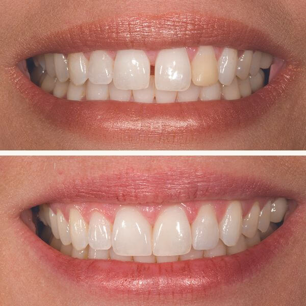 Conheça as causas prováveis de diastema