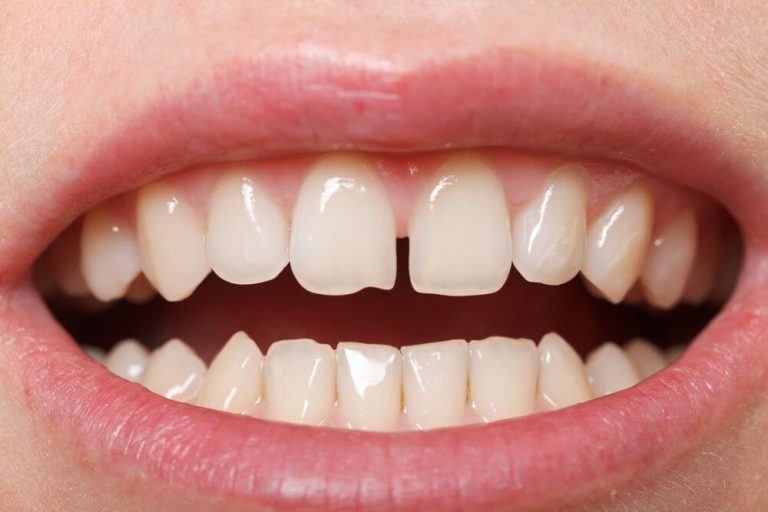 Diastema é um problema ou só charme Entenda o assunto!