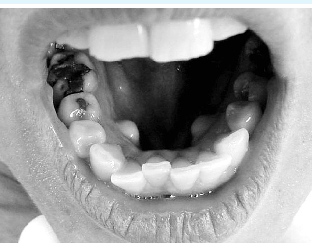 Quais são os sintomas do tórus mandibular