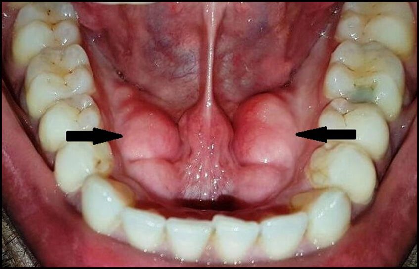 Tórus Mandibular e Palatino será que você tem Entenda o assunto!