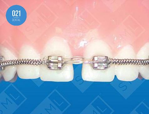 Correção do diastema utilizando aparelhos ortodônticos 