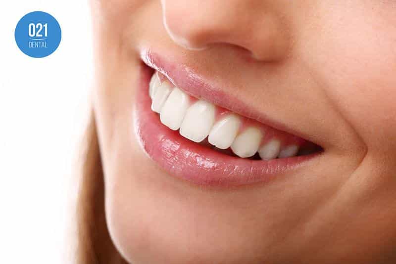 sorriso pós gengivoplastia