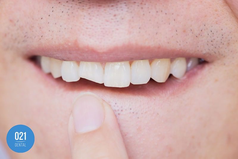 pessoa com dente quebrado