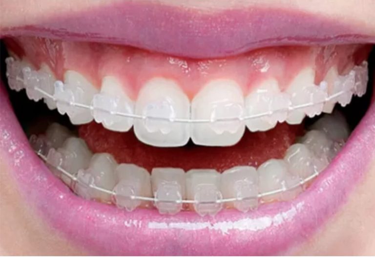 Aparelho de porcelana quem pode usar Guia BRdental