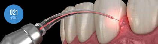 processo da gengivoplastia