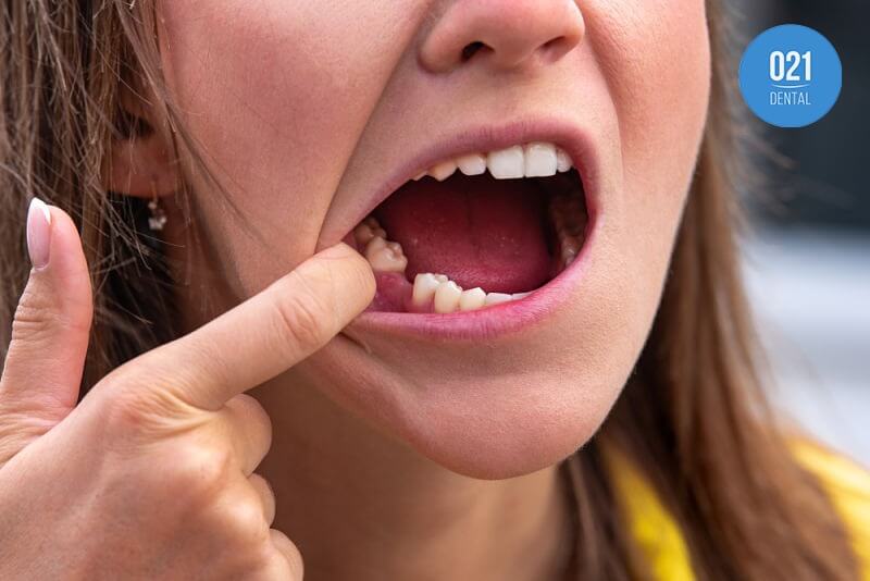 mulher com agenesia dentaria