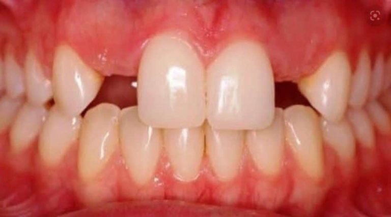 Agenesia dentária, a falta de dentes — Entenda o assunto!