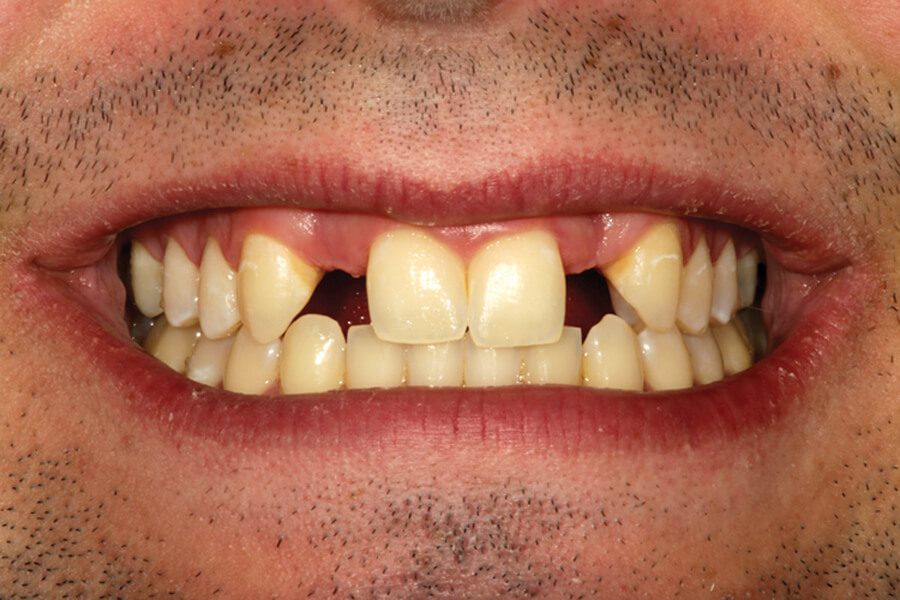 Agenesia dentária quais são as consequências