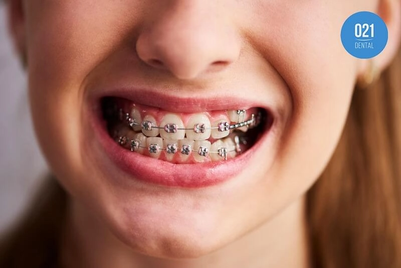 Menina utilizando aparelho fixo na correção dos dentes encavalados