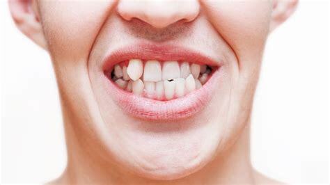 Dente encavalado Entenda mais sobre esse problema