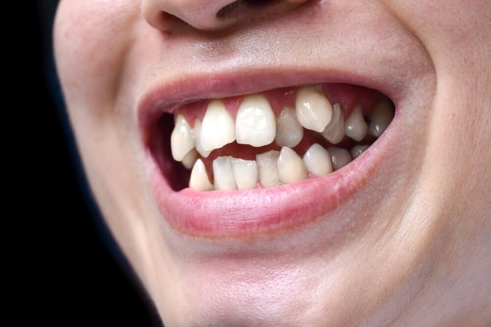 Dentes encavalados conheça as principais causas