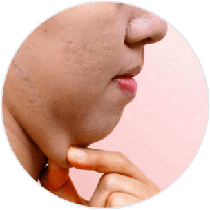 lipo-de-papada