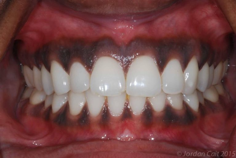 Minha gengiva está escura, o que pode ser BRdental