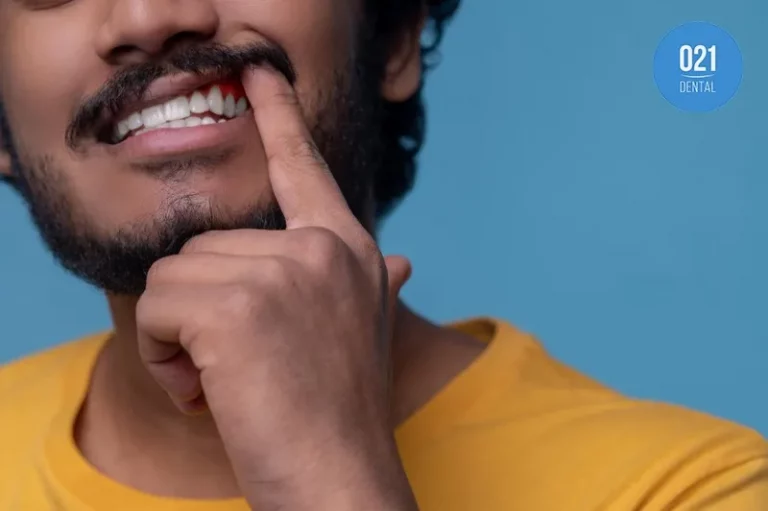 Imagem de um homem mostrando a sua gengiva escura