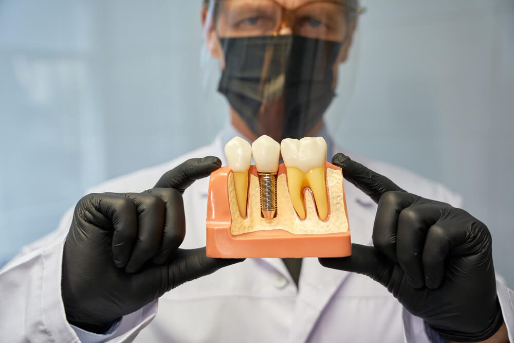 Como funciona um implante dentário