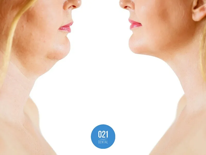 Mulher loira de meia idade mostrando antes e depois da lipo de papada em duas imagens